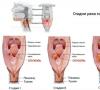 Проявление основных симптомов рака гортани