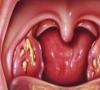 Причины, симптомы и методы лечения стафилококка в горле у взрослого или ребенка