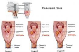 Проявление основных симптомов рака гортани