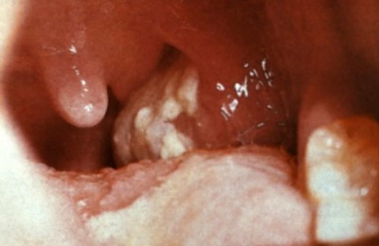 Amigdale purulente la copii - cauze, simptome, diagnostic și tratament - Pleurezie June
