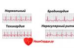 Metode pentru tratarea aritmiilor cardiace