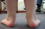 Deformarea valgus a piciorului la copii: cauze, semne, diagnostic și tratament