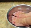 Hiperkeratoza picioarelor: cauze, simptome și tratament Hiperkeratoza călcâielor provoacă