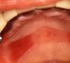 Umflarea gurii: cauze, simptome, tratamente tradiționale și populare, explicațiile medicului