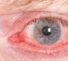 Picături pentru ochi de cataractă - tratament fără intervenție chirurgicală Cum se picură picături după operația de cataractă