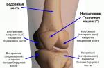 Timpul de tratament pentru o fractură a condilului articulației genunchiului Condil tibial lateral