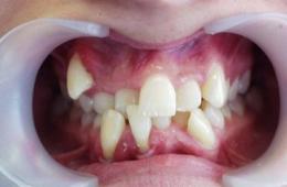 Hiperdonția - număr anormal de dinți (dinți supranumerari)