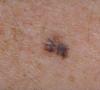 Diagnosticul melanomului în stadiul inițial, simptomele și tratamentul neoplasmelor maligne