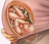 Hoe aambeien bij zwangere vrouwen behandelen?
