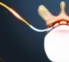 Deteriorarea rădăcinilor nervoase și a plexurilor Dorsalgie vertebrală mcb 10