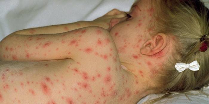 Primele semne de varicelă la copii: cum începe