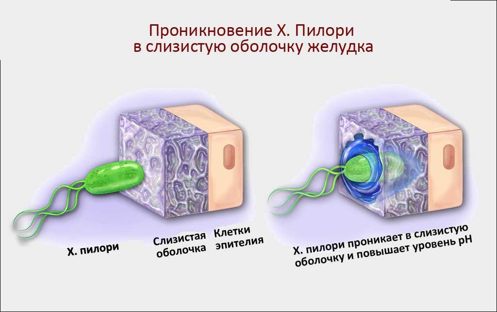Helicobacter pylori bakterisi: belirtiler, nedenler ve tedavi