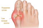 Tratamentul gutei cu remedii populare, cum să tratați artrita gutoasă pe degetele de la picioare
