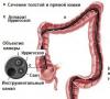 Kako pregledati crijeva bez kolonoskopije?