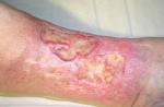 Ulcer trofic - cauze, simptome, tratament și etape