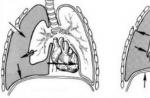 Uzroci i znakovi valvularnog pneumotoraksa Naprezanje valvularnog pneumotoraksa