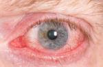 Kapi za oči od mrene - liječenje bez operacije Kako kapati kapi nakon operacije mrene