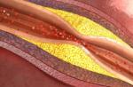 Kako ukloniti kolesterol iz krvnih žila tijela