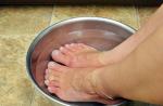 Hiperkeratoza stopala: uzroci, simptomi i liječenje Hiperkeratoza peta uzrokuje