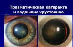 Tipuri și tratament al cataractei traumatice Cum și de ce se dezvoltă boala