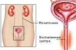 Ureaplasma parvum u razmazima kod žena i muškaraca Znakovi ureaplasma parvum kod muškaraca