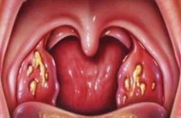 Penyebab, gejala dan cara pengobatan staphylococcus di tenggorokan pada orang dewasa atau anak-anak