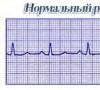 I49 Alte tulburări ale ritmului cardiac