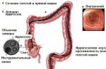 Kako pregledati crijeva bez kolonoskopije?